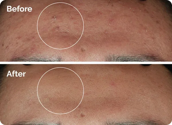 The Ordinary Niacinamide 10% + Zinc 1% - Vista 2